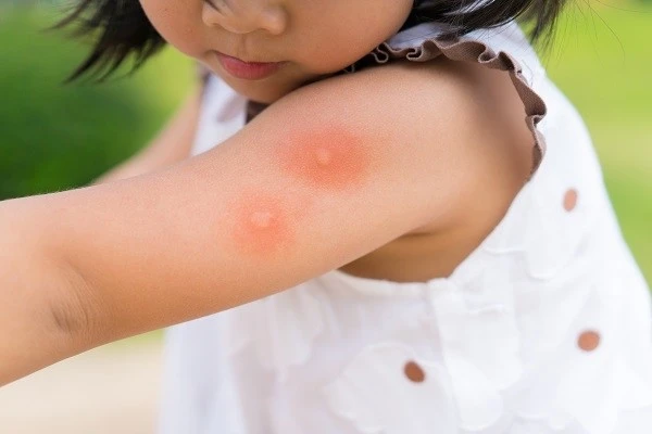 在美国被蜱虫咬了怎么办？夏季防蜱全攻略：详尽指南、专业解读与最新数据