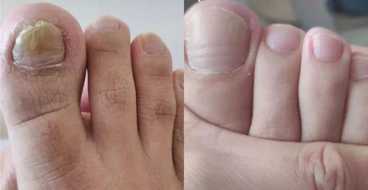 灰指甲怎么治才会好?美国药房能买什么、什么时候该看医生,一篇讲清楚 2 image 383